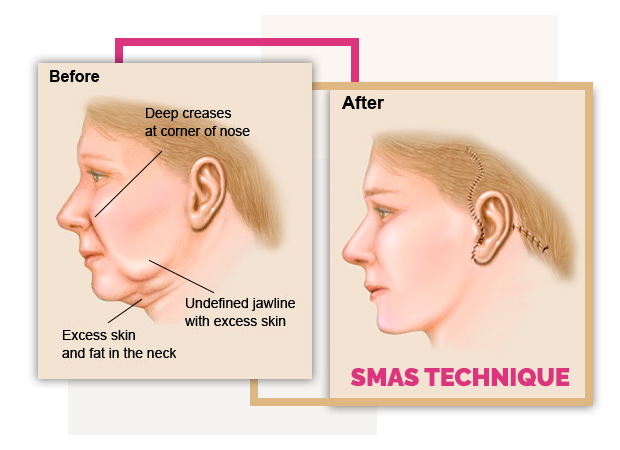 SMAS Procedure