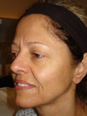 Patient Michele before surgery