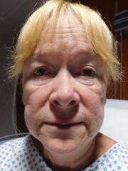 Patient Pam before surgery